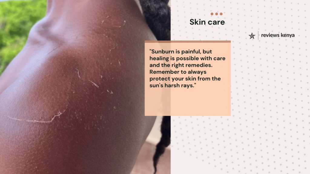 How to Get Rid of Sunburns with Kenyan Products for All Skin Types